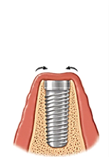 Implants dentaires Strasbourg 6